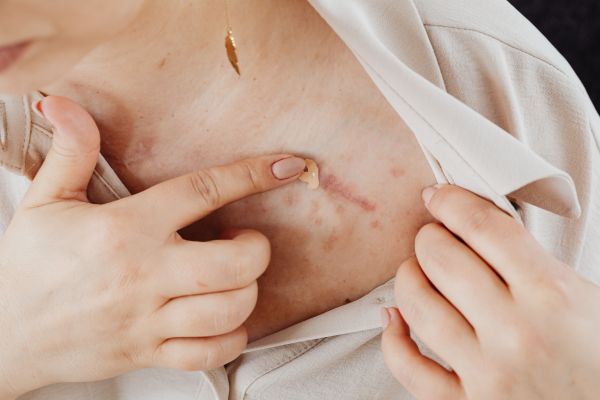 Découvrez les bienfaits de la crème cicatrisante pour apaiser la peau